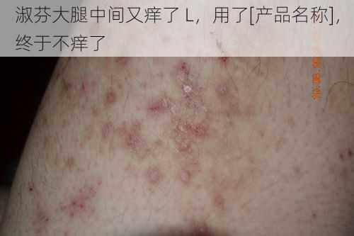 淑芬大腿中间又痒了 L，用了[产品名称]，终于不痒了